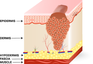 Staging Squamous Cell Skin Cancer: A Practical Description – Skin ...