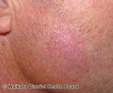 Staging Basal Cell Carcinoma: High-Risk Features – Skin Cancer ...